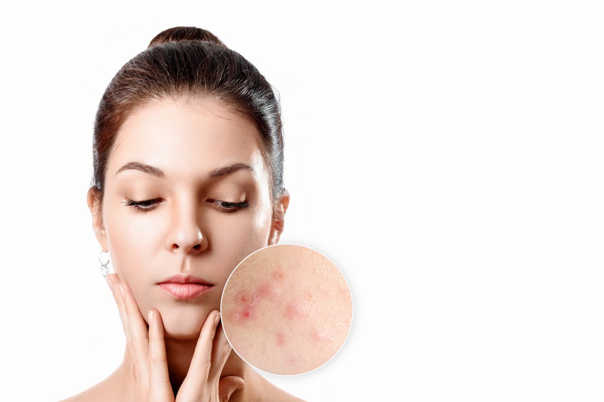 acne treatment for teens